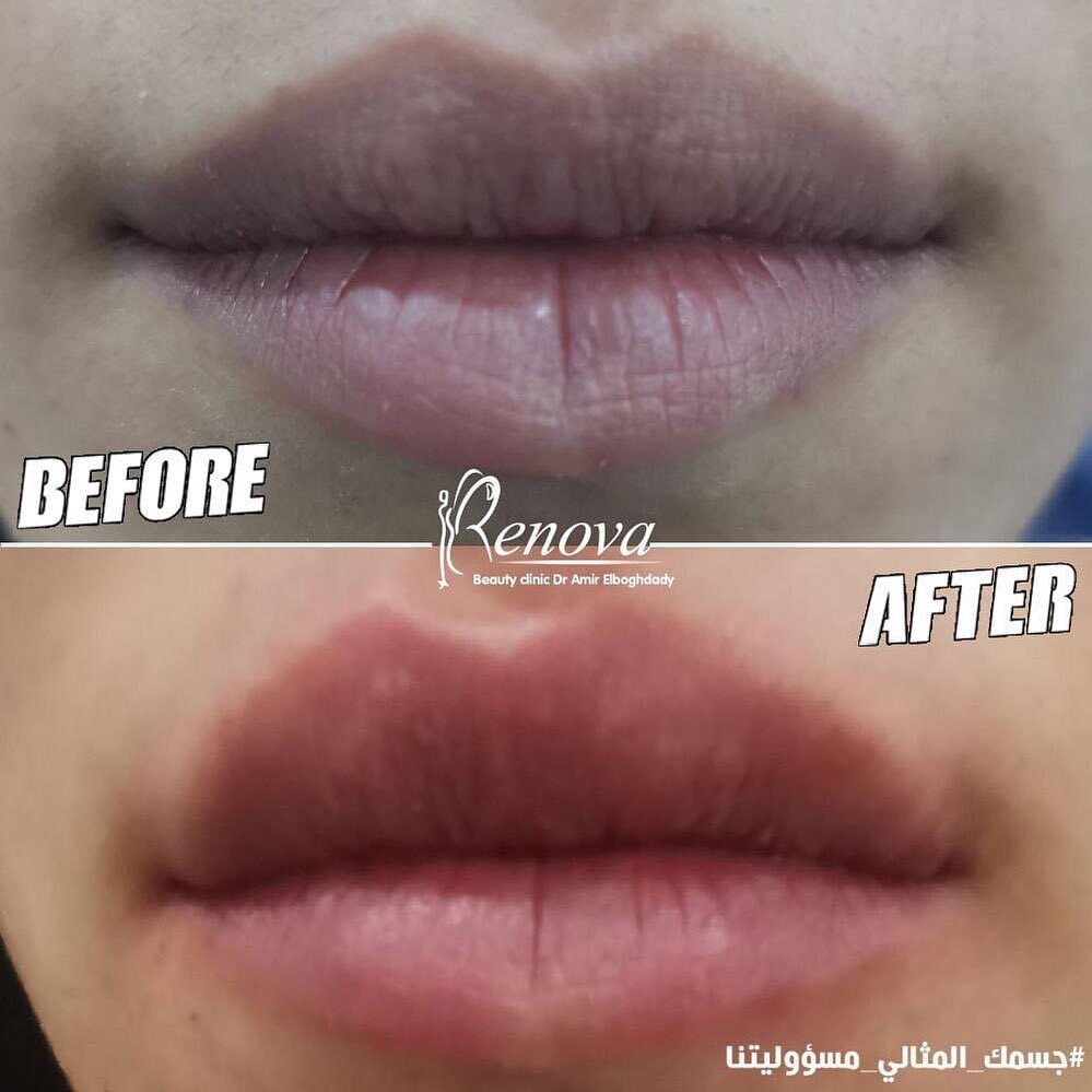 Before and After Result